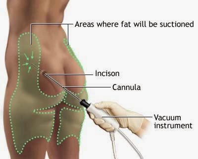 Liposuction area