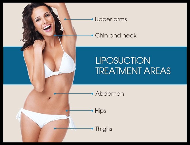 Liposuction areas to remove fat