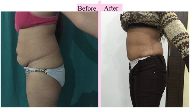 Tummy Tuck results