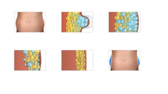 Cryolipolysis Treatment