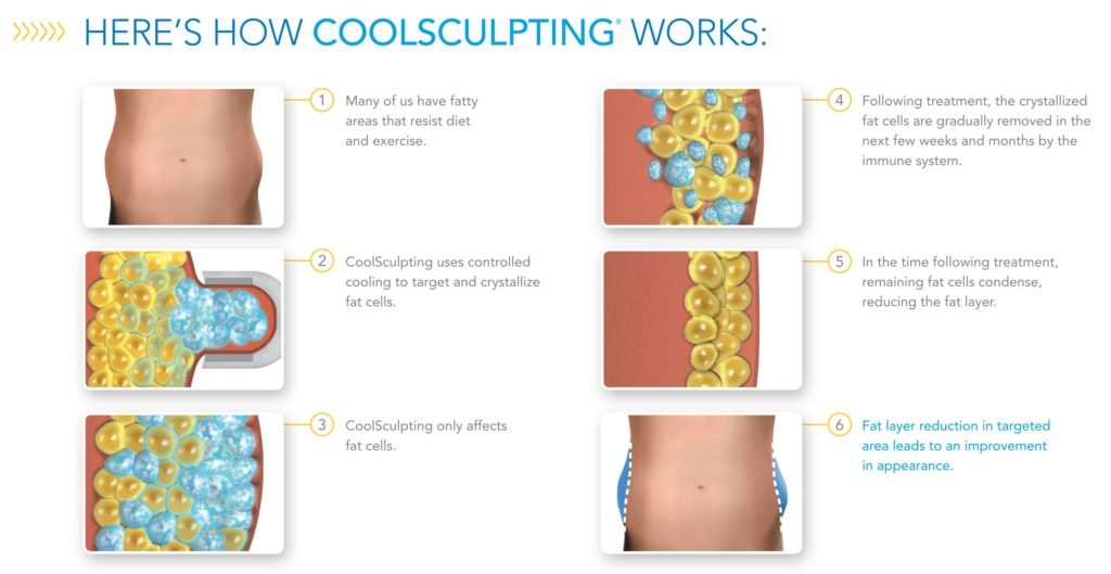 How CoolSculpting is right for you
