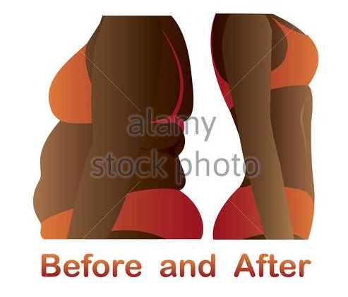 Discover Slimmer You With CoolSculpting or Cryolipolysis