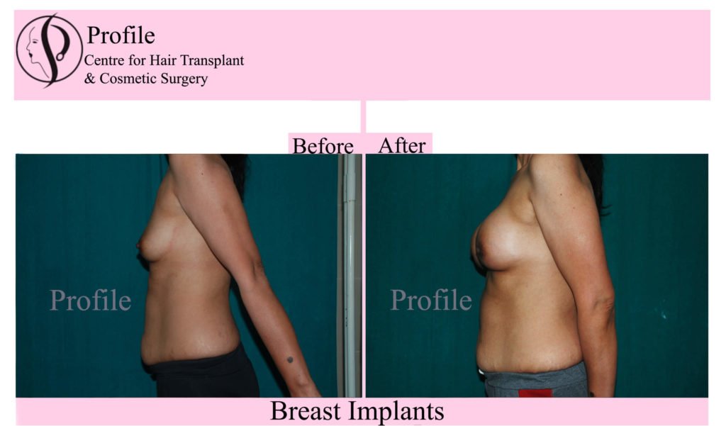 breast augmentation