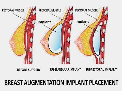 breast augmentation surgery