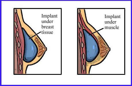 breast augmentation surgeries