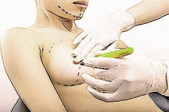 breast augmentation