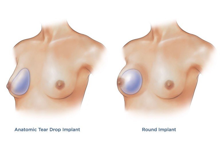 Breast implants