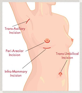 Breast Augmentation areas