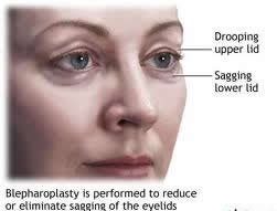 Blepharoplasty 