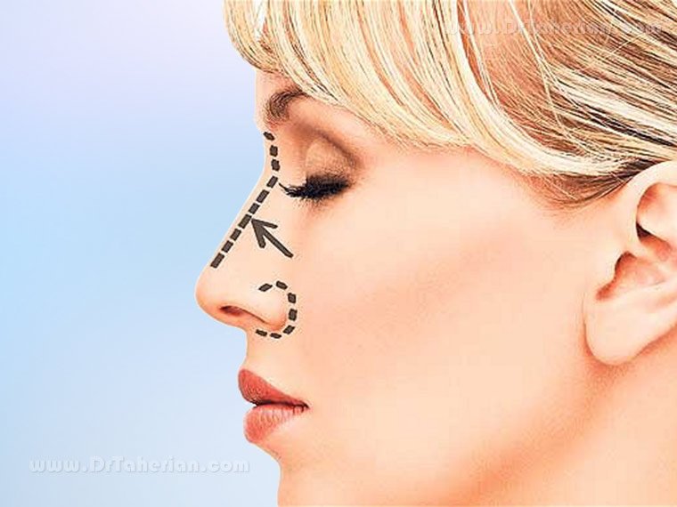 Rhinoplasty nose job