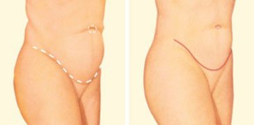 Tummy Tuck Surgery