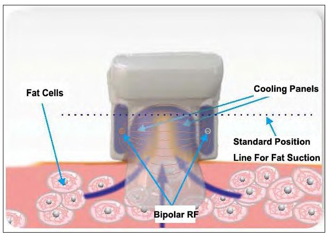 Cryolipolysis