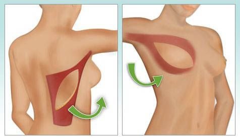 Breast Reduction