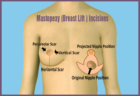 Breast Reduction Incisions