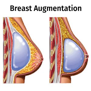 Breast Augmentation 