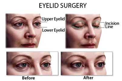 Blepharoplasty or Eyelid Rectification
