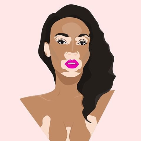 Vitiligo