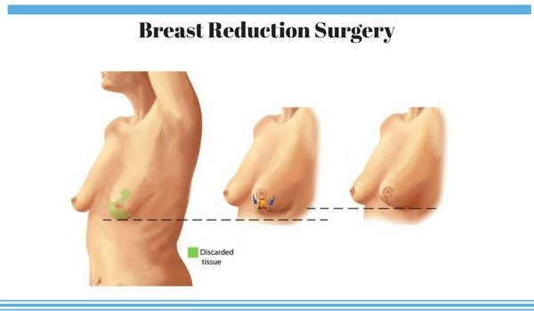 Breast Reduction Surgery