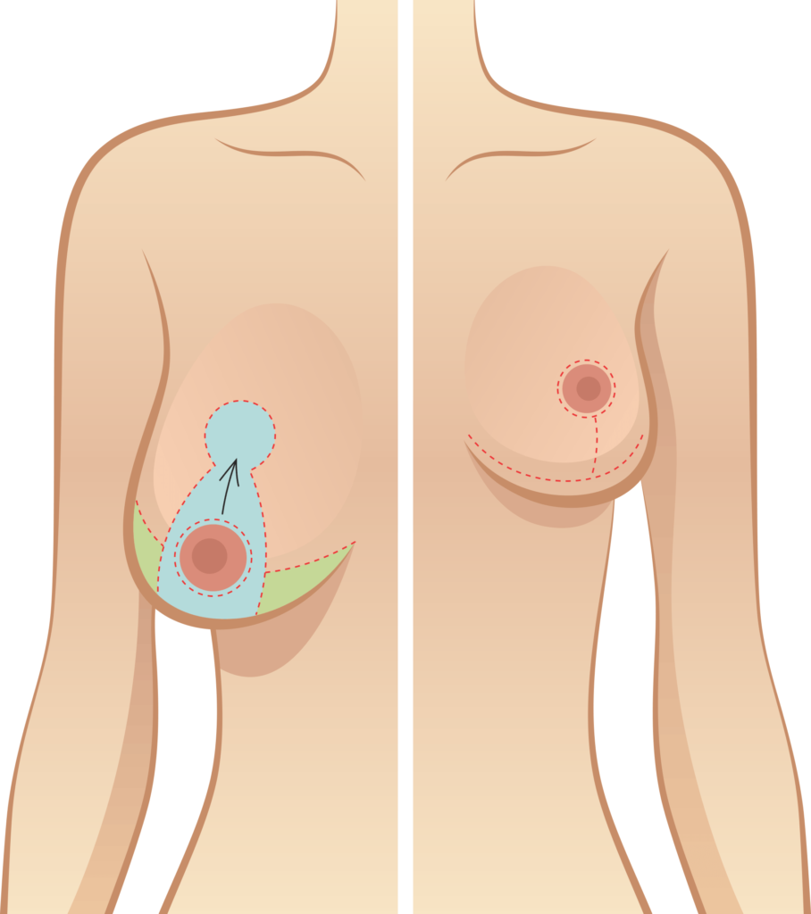 Breast Reduction