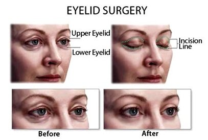 Eyelid Surgery
