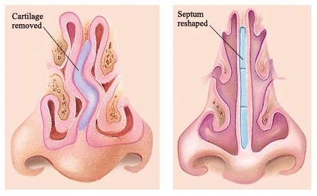 Rhinoplasty