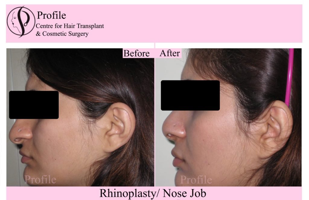 Rhinoplasty results