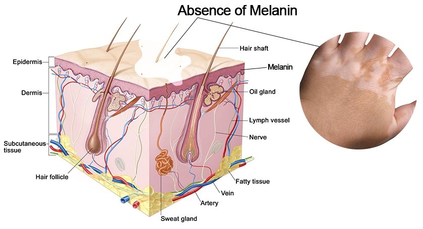 Vitiligo absence
