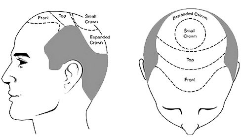 Hair transplant area