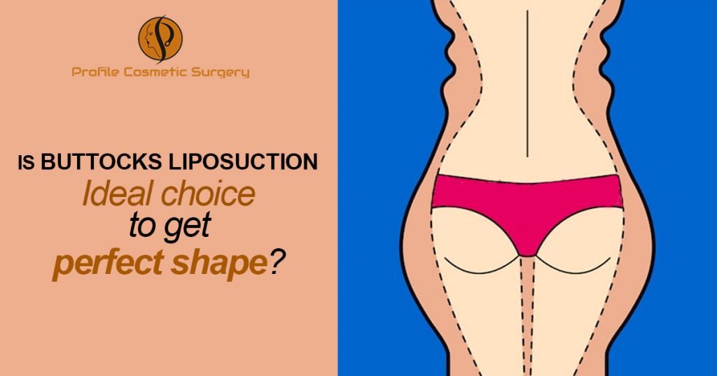 Buttocks-Liposuction