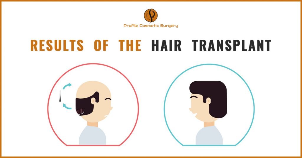Results of the hair transplant Ludhiana, Punjab