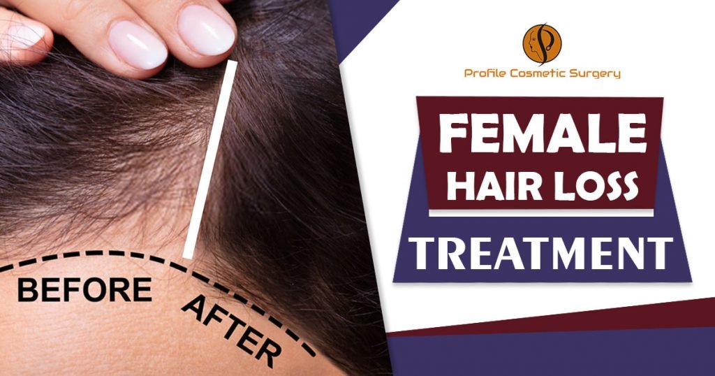 Female hair loss treatment