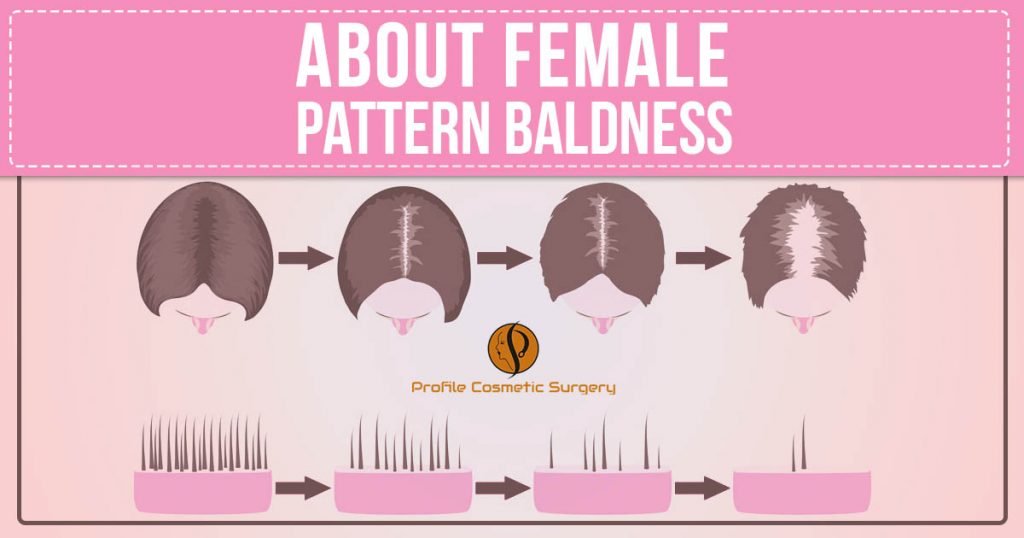 about female pattern baldness