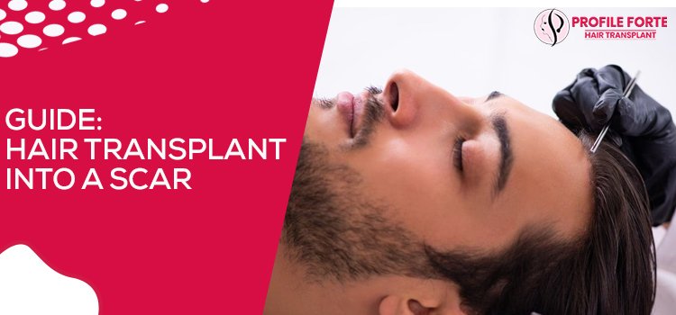 Guide Hair Transplant Into A Scar