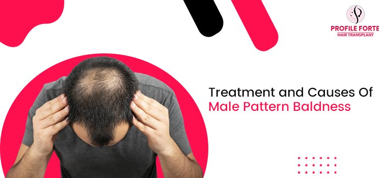 Treatment and Causes Of Male Pattern Baldness